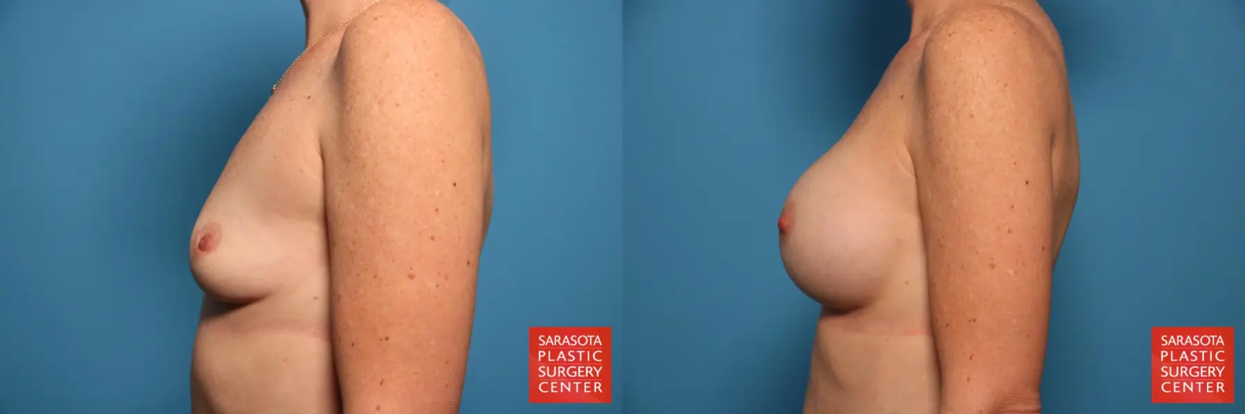 Breast Augmentation: Patient 50 - Before and After 3