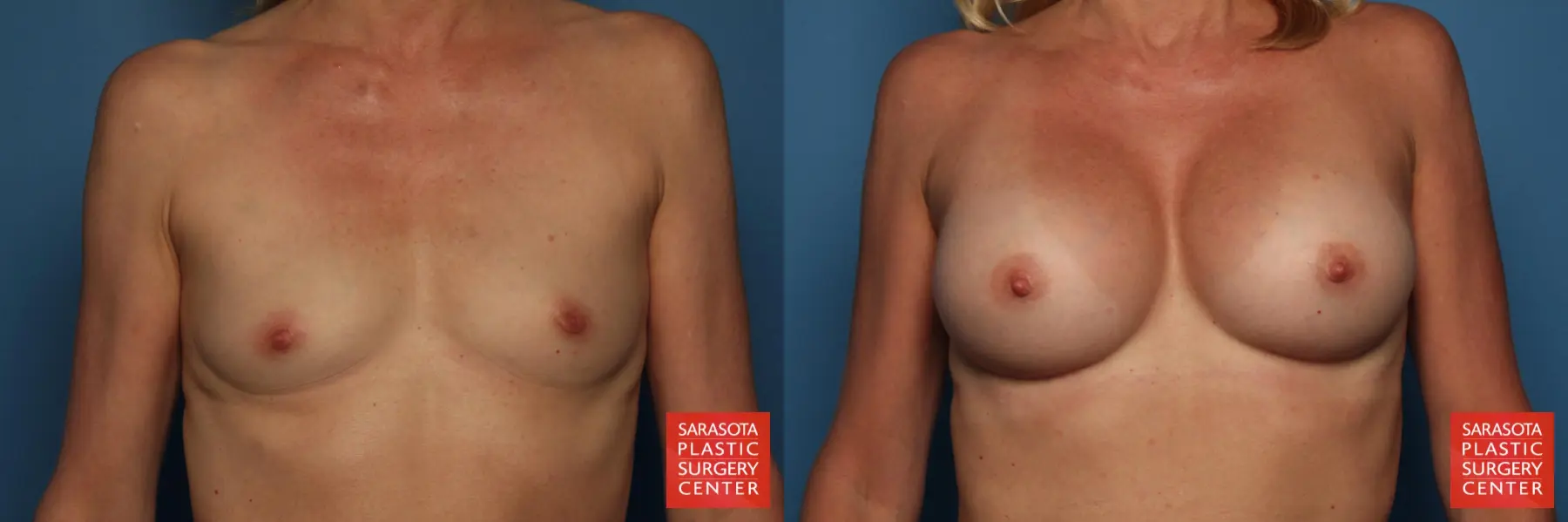 Breast Augmentation: Patient 28 - Before and After 1