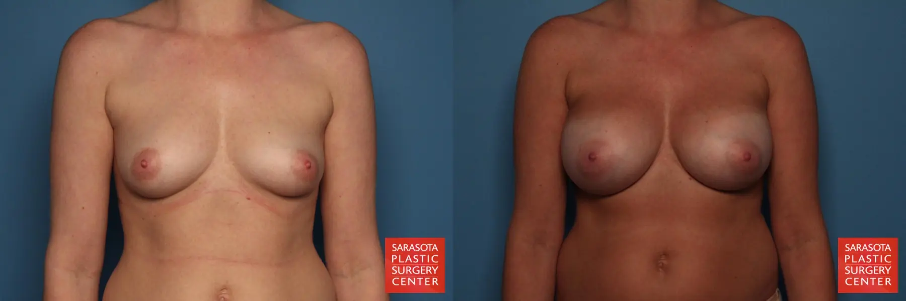 Breast Augmentation: Patient 20 - Before and After 1