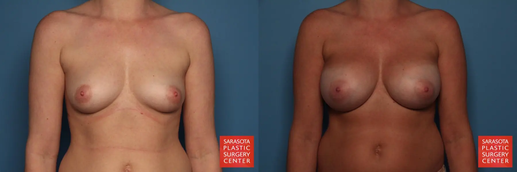 Breast Augmentation: Patient 26 - Before and After  