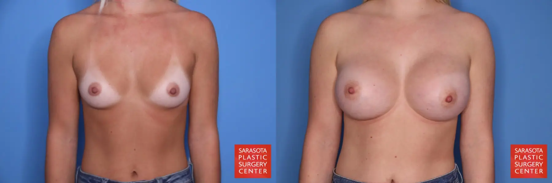 Breast Augmentation: Patient 202 - Before and After 1