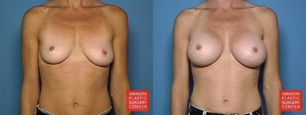 Breast Augmentation: Patient 37 - Before and After 1