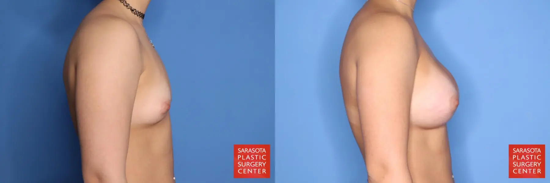 Breast Augmentation: Patient 212 - Before and After 5