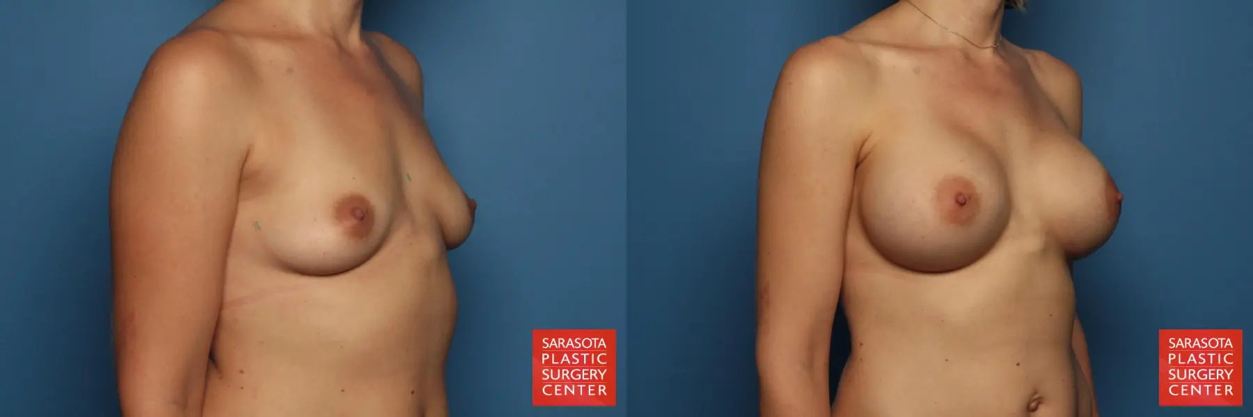 Breast Augmentation: Patient 66 - Before and After 2