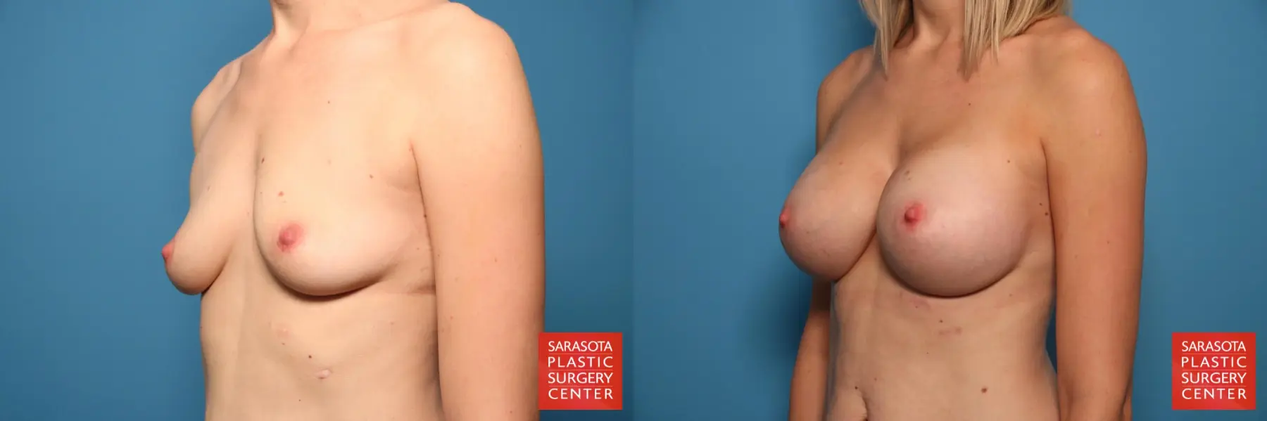 Breast Augmentation: Patient 49 - Before and After 2