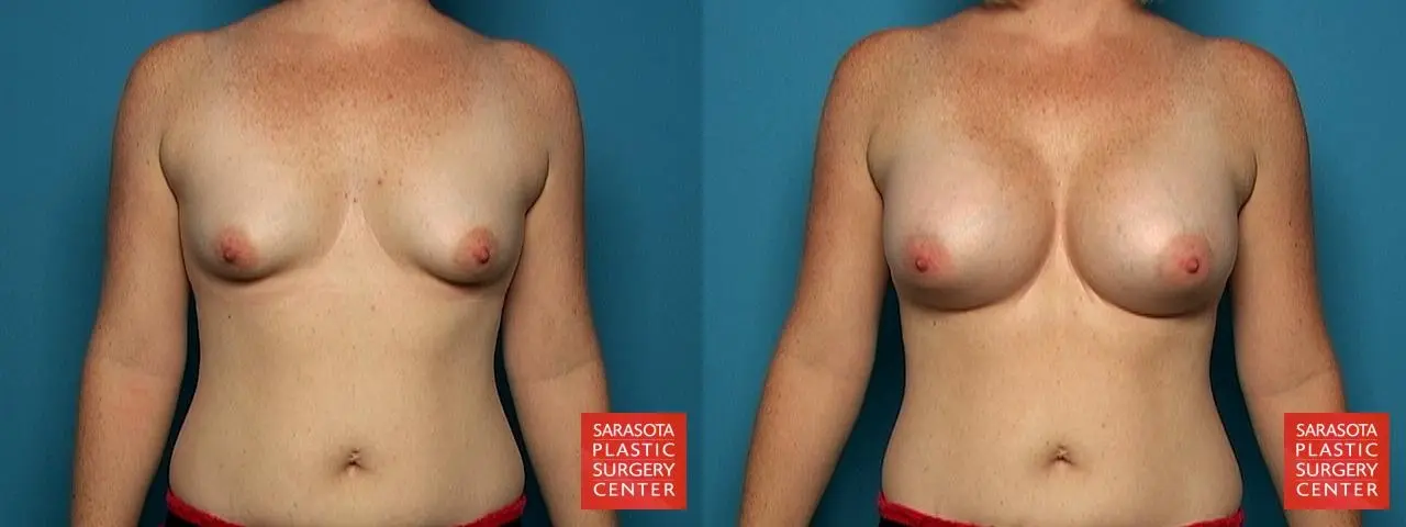 Breast Augmentation: Patient 23 - Before and After  