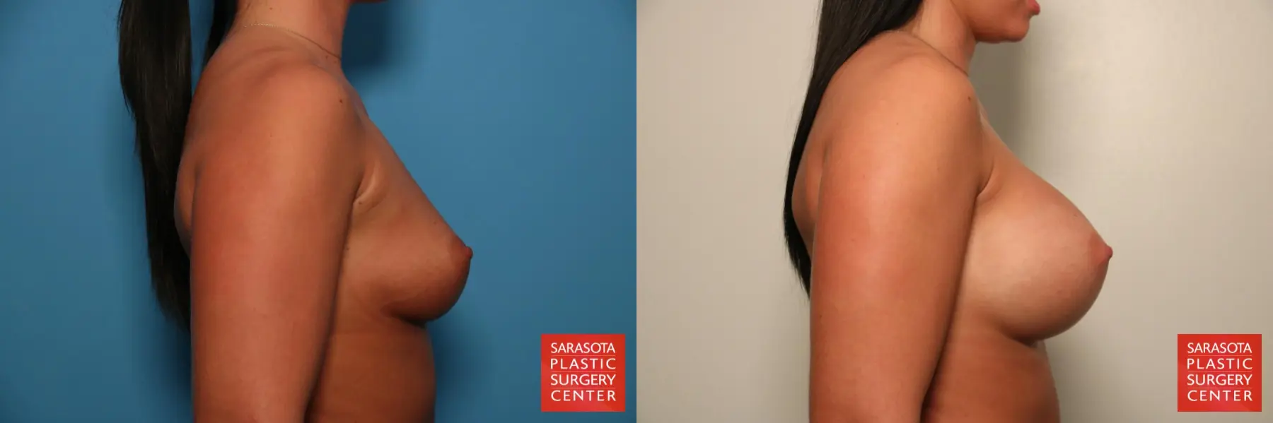 Breast Augmentation: Patient 55 - Before and After 3