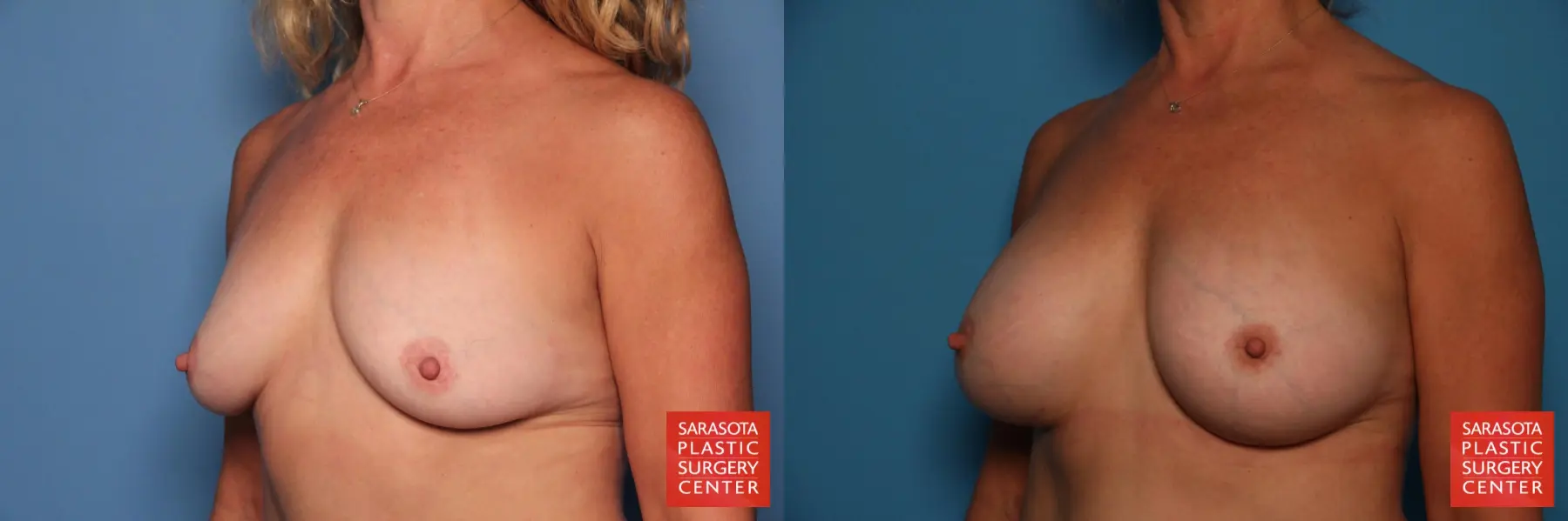 Breast Augmentation: Patient 27 - Before and After 2