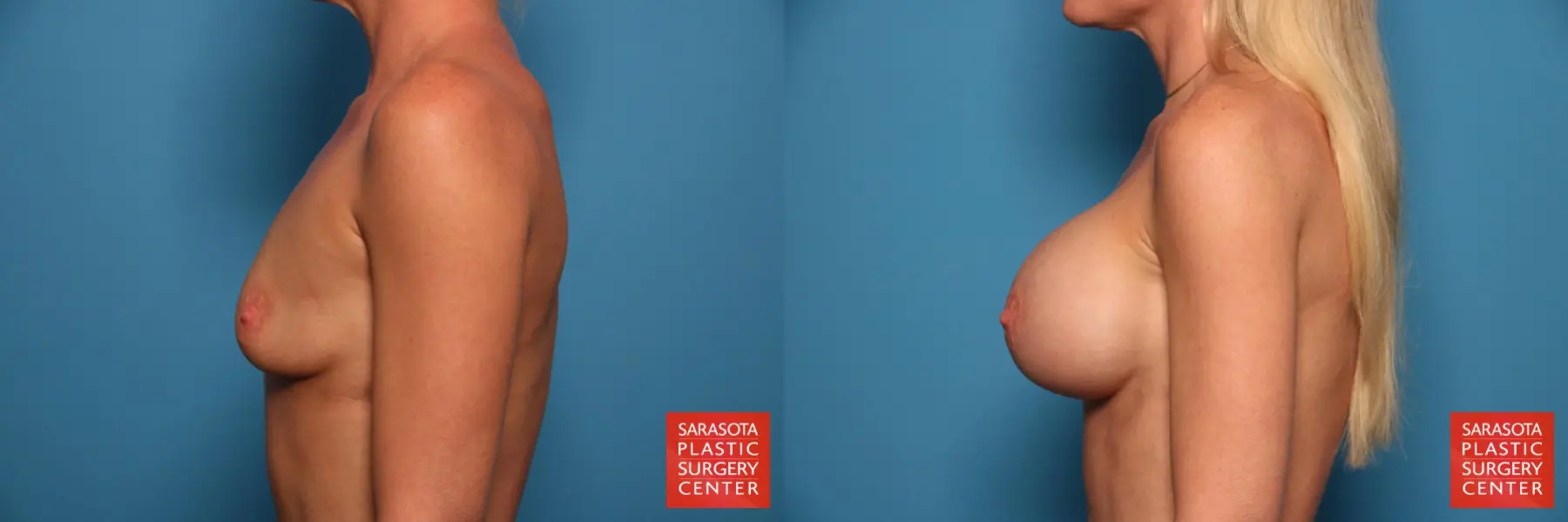 Breast Augmentation: Patient 61 - Before and After 3