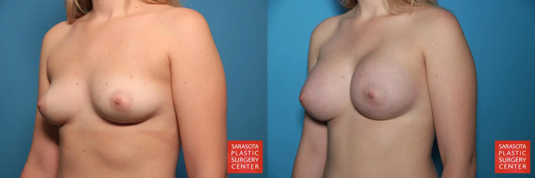 Breast Augmentation: Patient 59 - Before and After 2