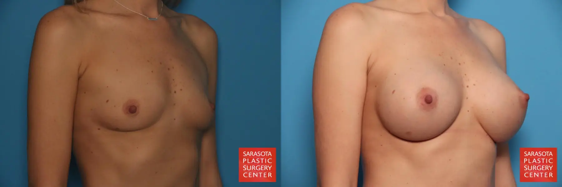 Breast Augmentation: Patient 76 - Before and After 2