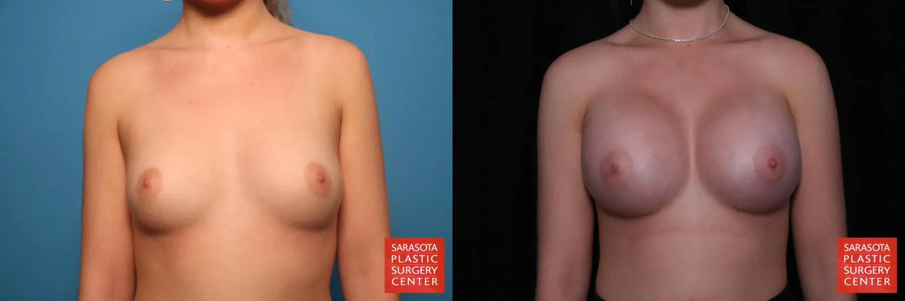 Breast Augmentation: Patient 53 - Before and After 1