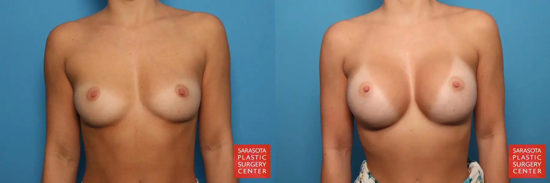 Breast Augmentation: Patient 7 - Before and After 1