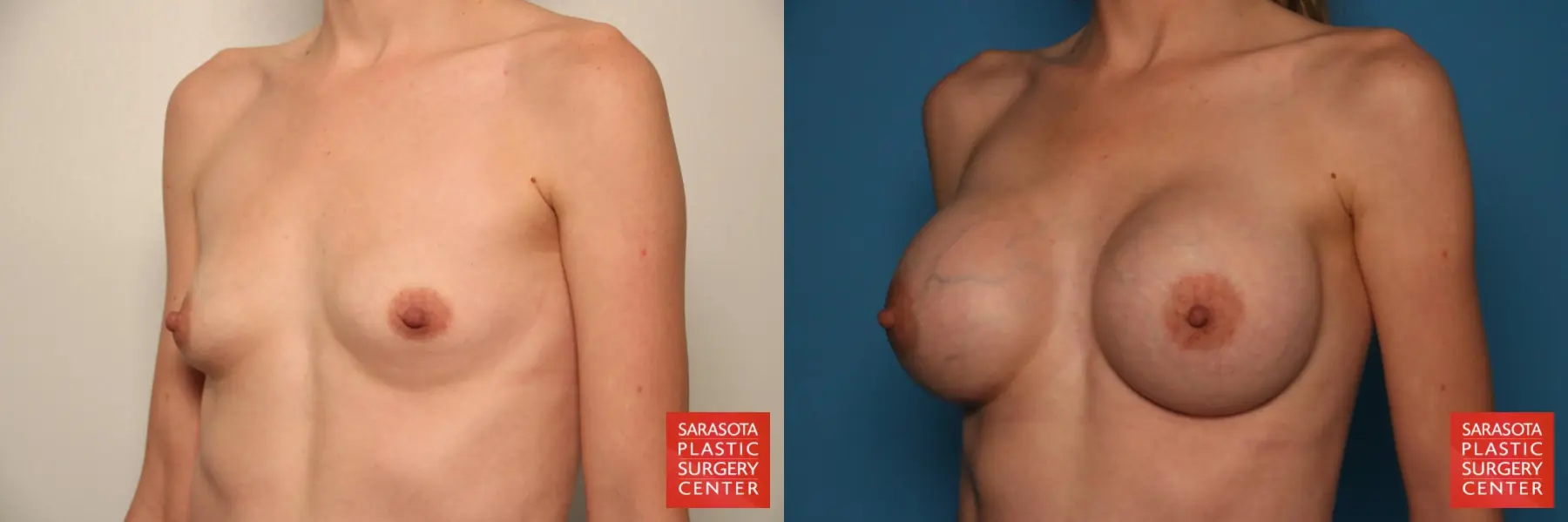 Breast Augmentation: Patient 62 - Before and After 2