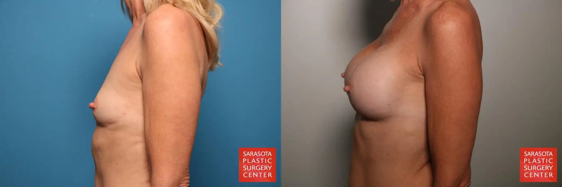 Breast Augmentation: Patient 58 - Before and After 3