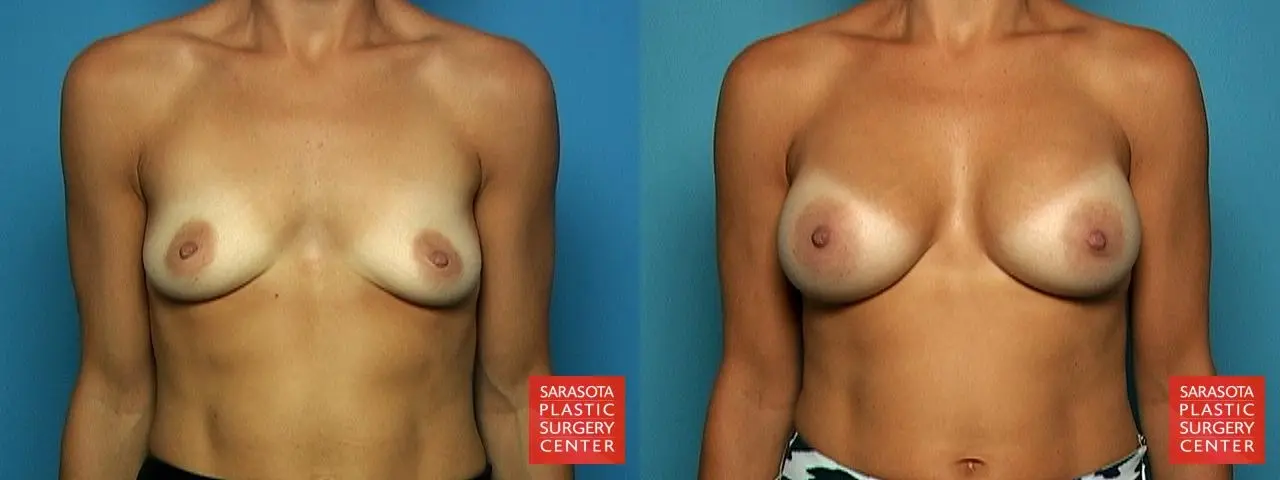 Breast Augmentation: Patient 47 - Before and After 1