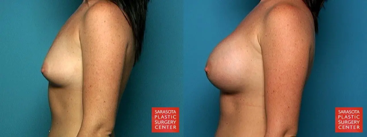 Breast Augmentation: Patient 14 - Before and After 3