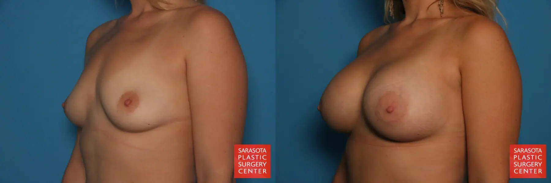 Breast Augmentation: Patient 68 - Before and After 2