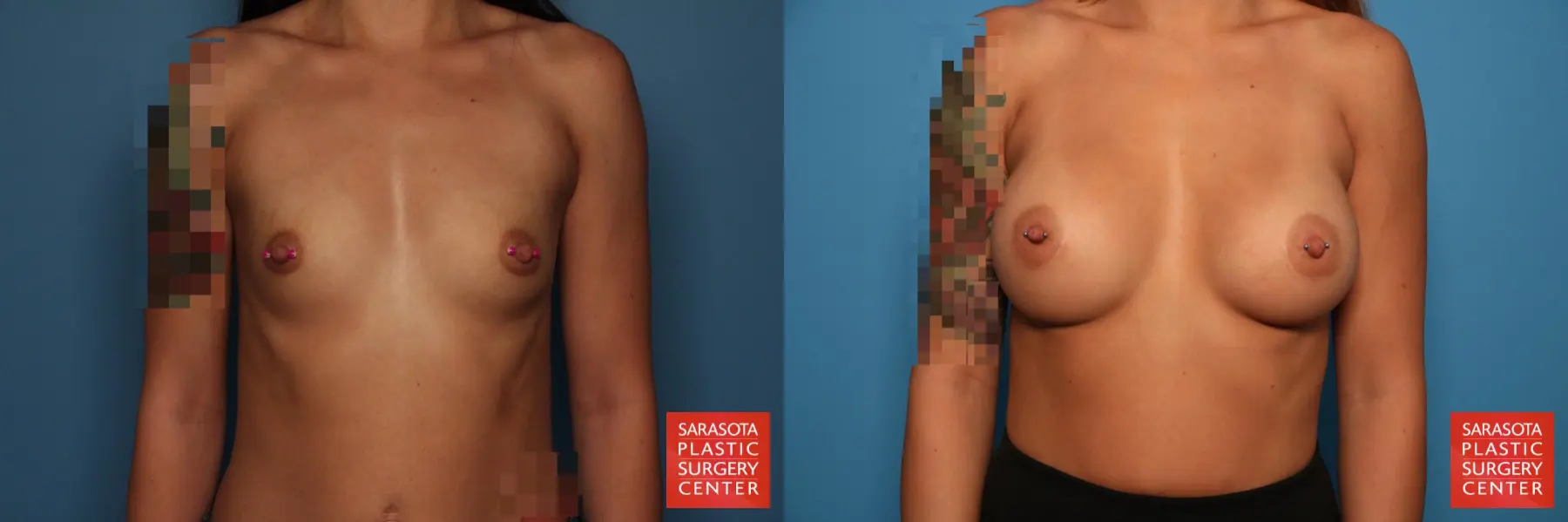 Breast Augmentation: Patient 37 - Before and After  