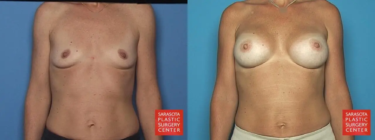 Breast Augmentation: Patient 35 - Before and After 1