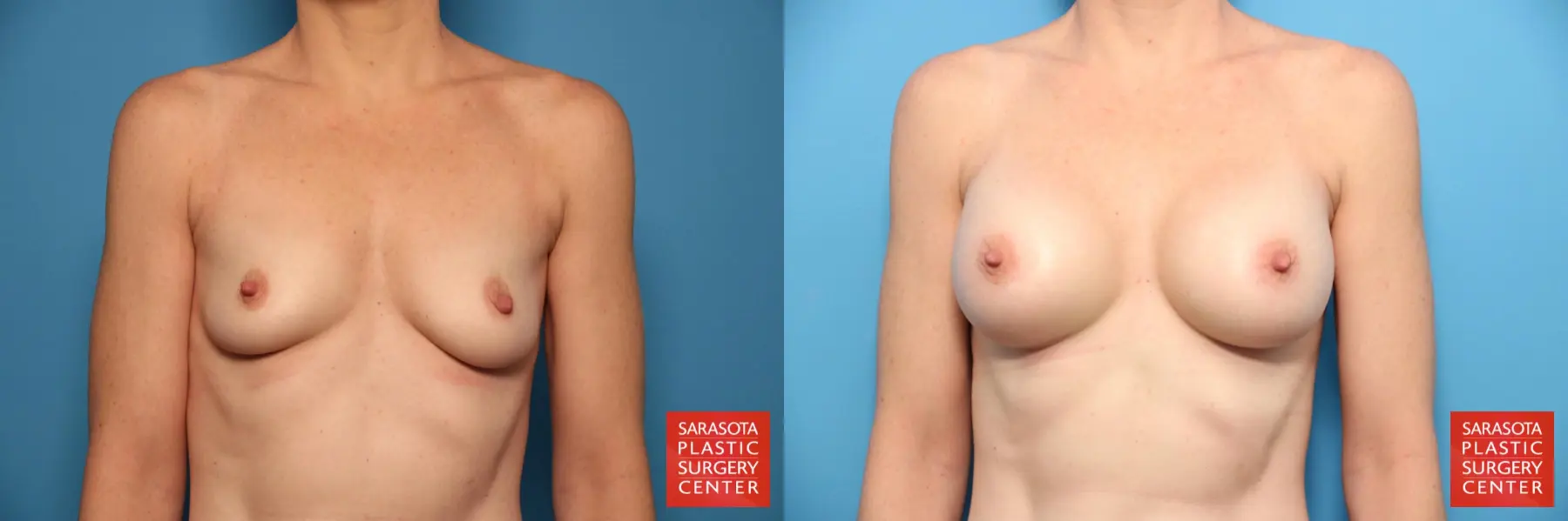 Breast Augmentation: Patient 12 - Before and After  