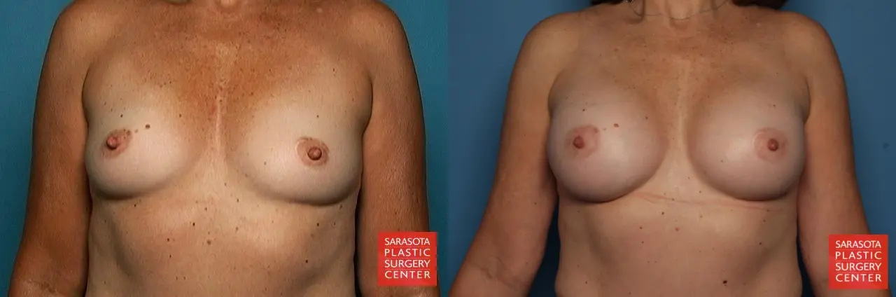 Breast Augmentation: Patient 44 - Before and After 1
