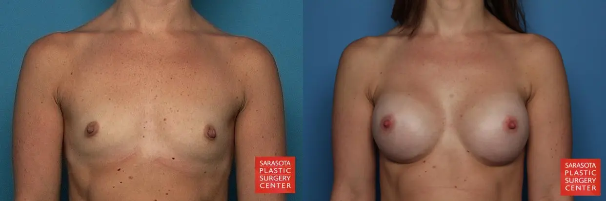 Breast Augmentation: Patient 24 - Before and After 1