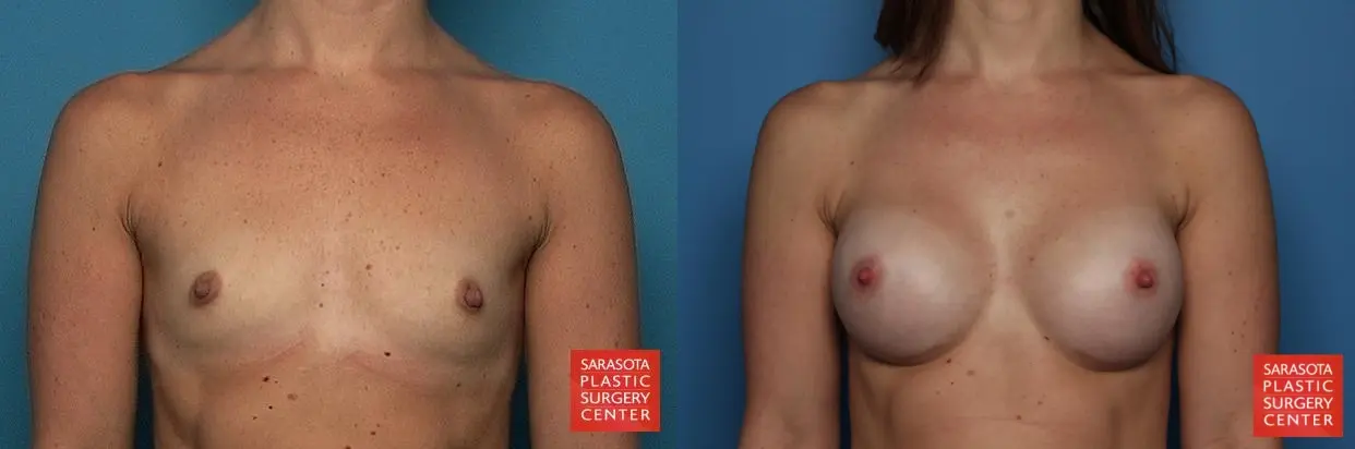 Breast Augmentation: Patient 9 - Before and After  