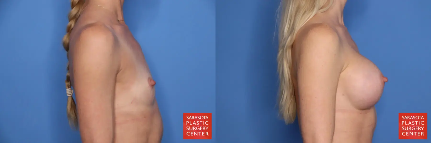 Breast Augmentation: Patient 203 - Before and After 3