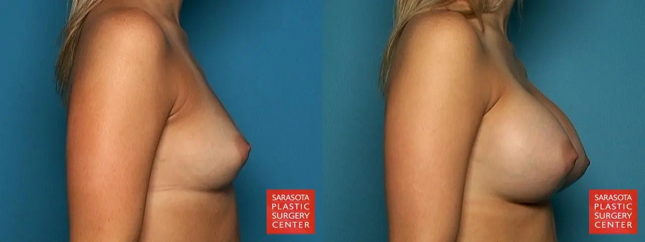Breast Augmentation: Patient 48 - Before and After 3