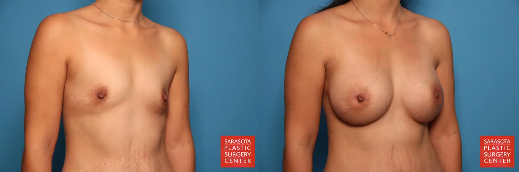Breast Augmentation: Patient 25 - Before and After 2