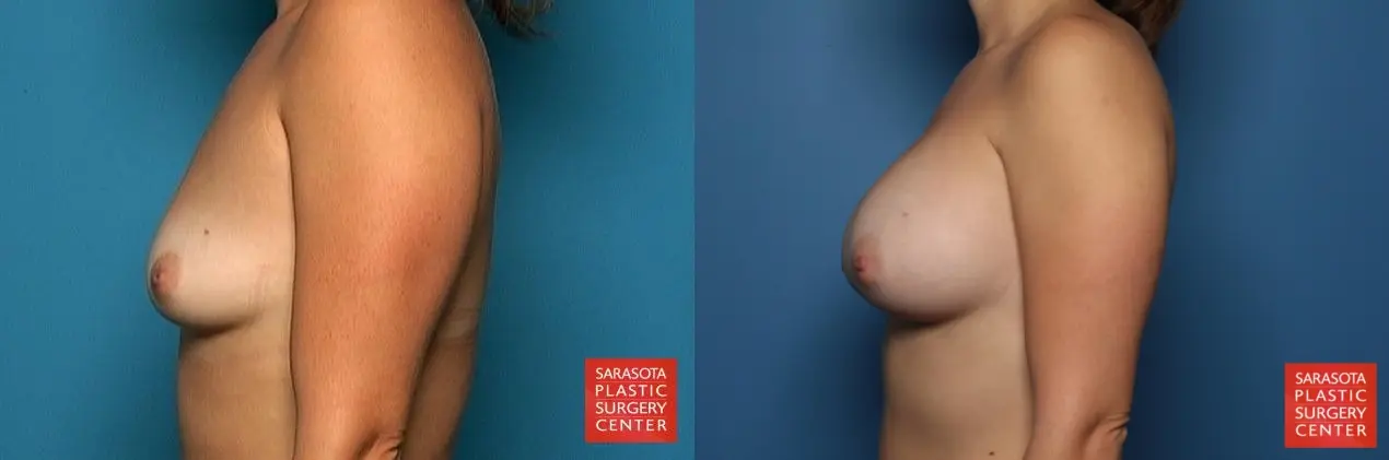 Breast Augmentation: Patient 51 - Before and After 3