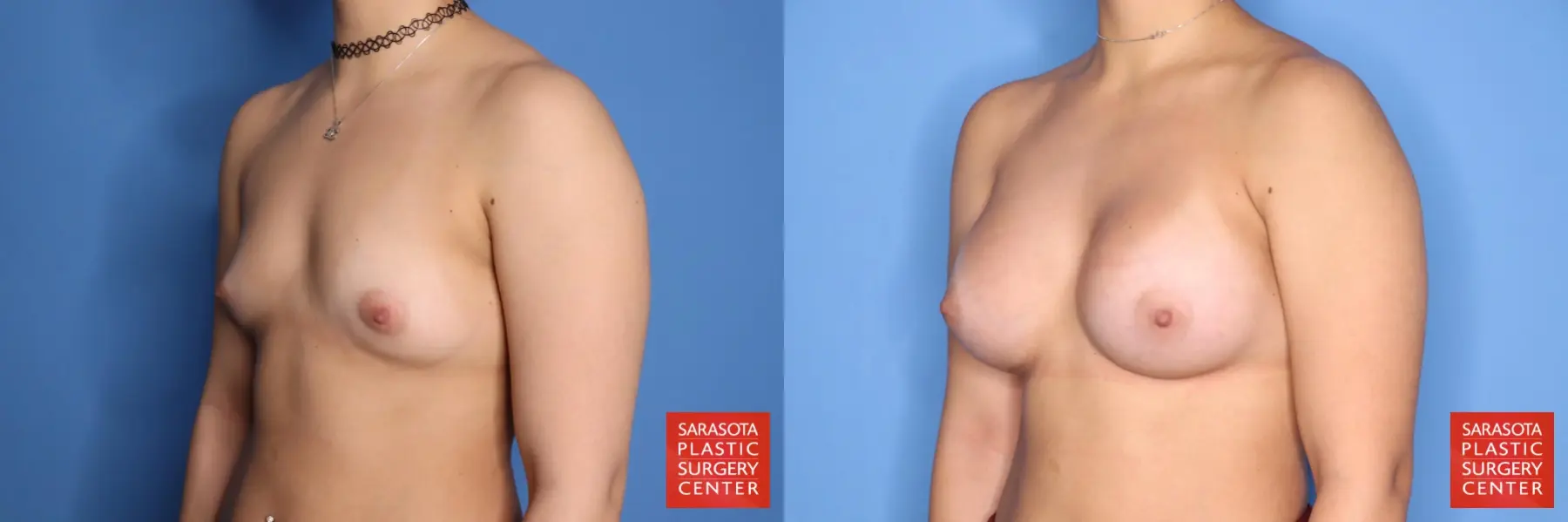 Breast Augmentation: Patient 212 - Before and After 2