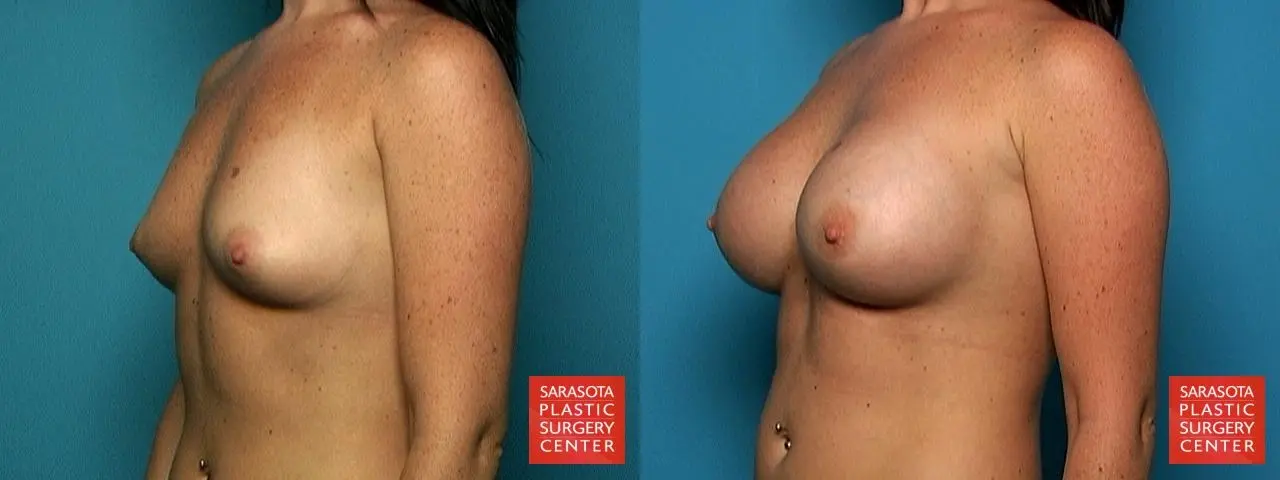 Breast Augmentation: Patient 10 - Before and After 2