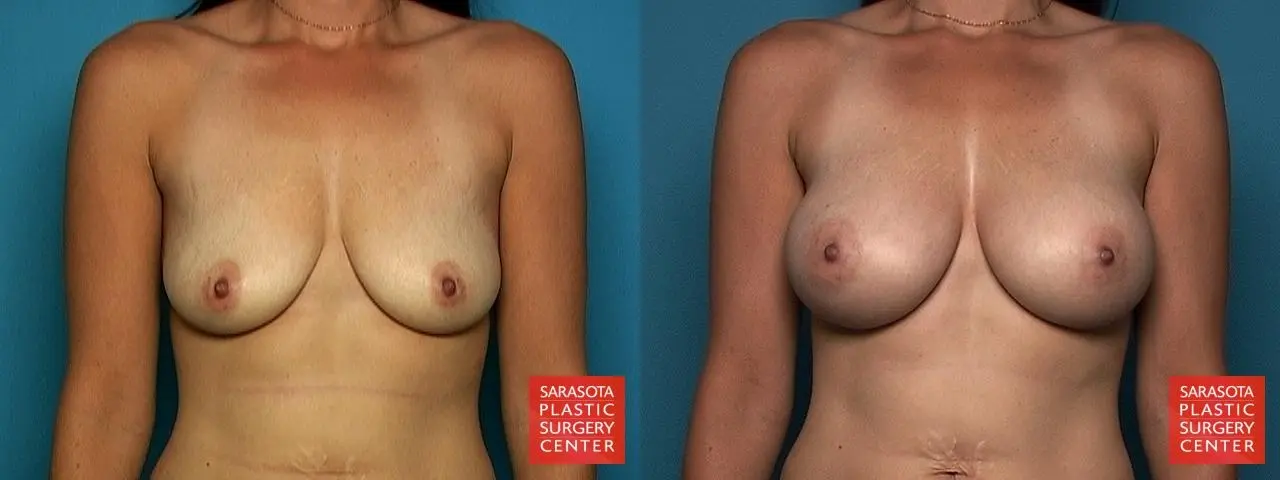 Breast Augmentation: Patient 2 - Before and After  
