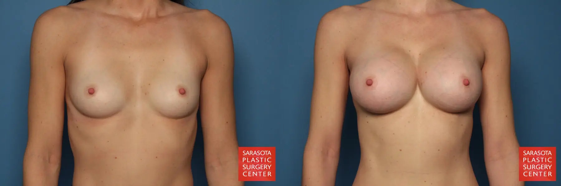 Breast Augmentation: Patient 39 - Before and After 1