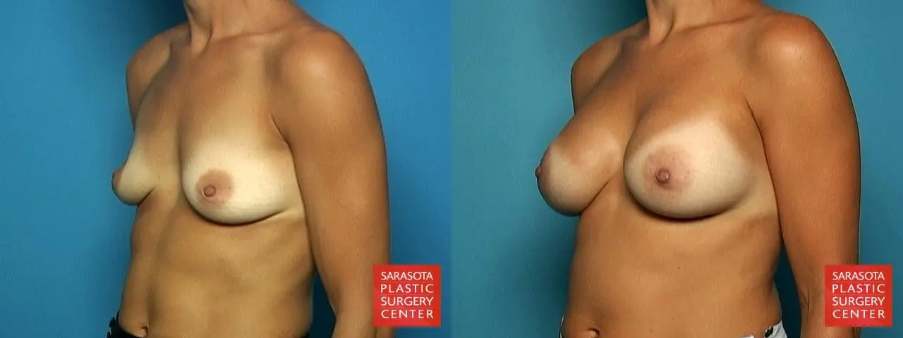 Breast Augmentation: Patient 47 - Before and After 2