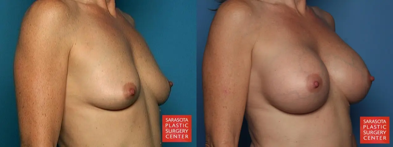 Breast Augmentation: Patient 1 - Before and After 2