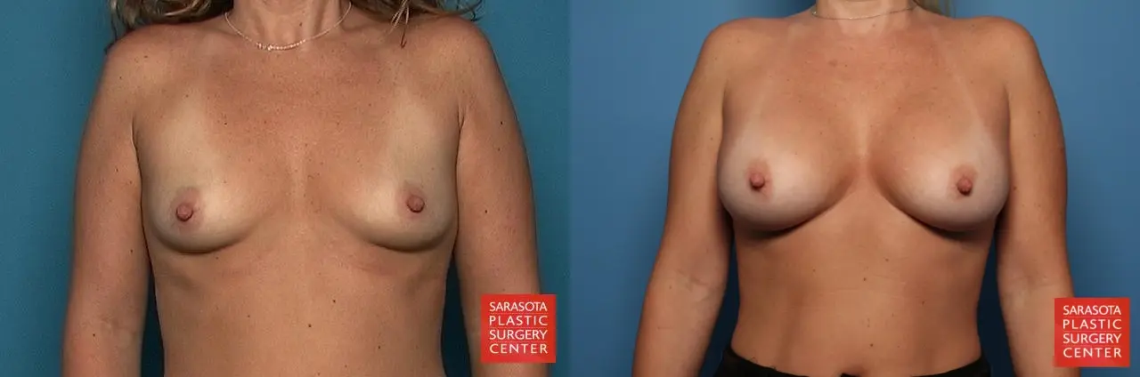 Breast Augmentation: Patient 57 - Before and After 1