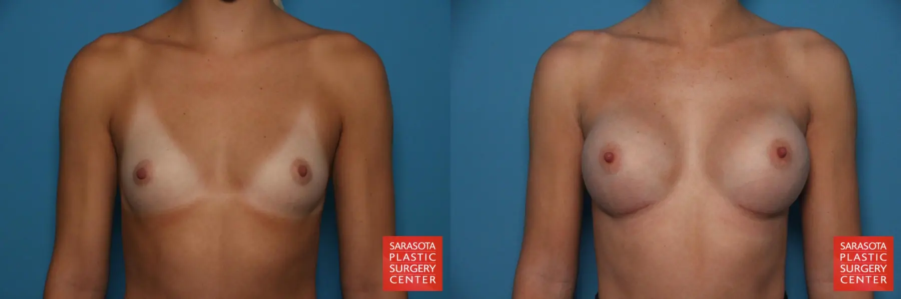 Breast Augmentation: Patient 77 - Before and After 1