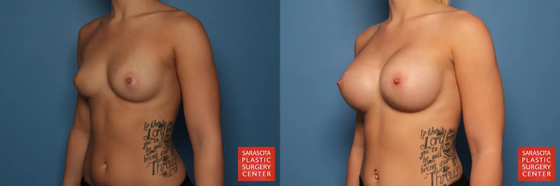 Breast Augmentation: Patient 22 - Before and After 2
