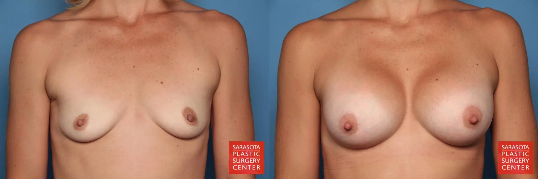 Breast Augmentation: Patient 33 - Before and After 1