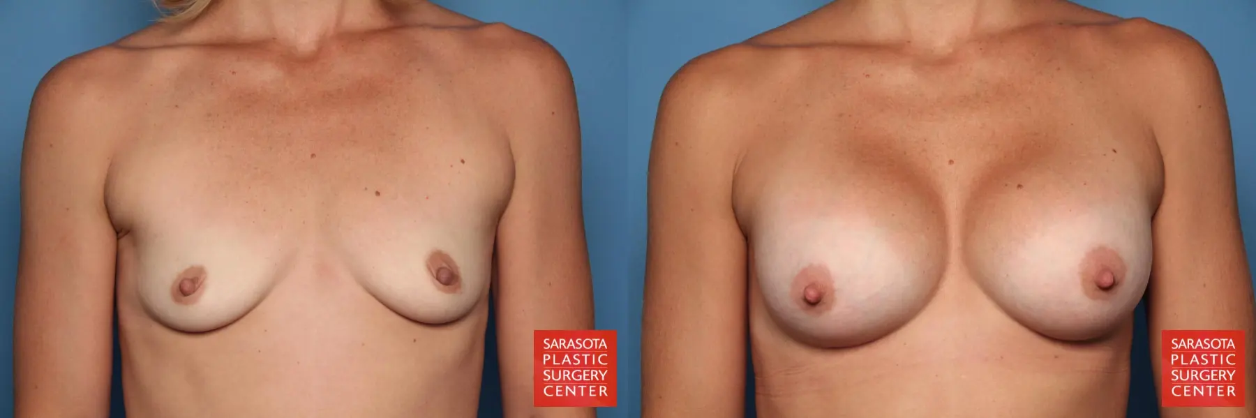 Breast Augmentation: Patient 31 - Before and After  