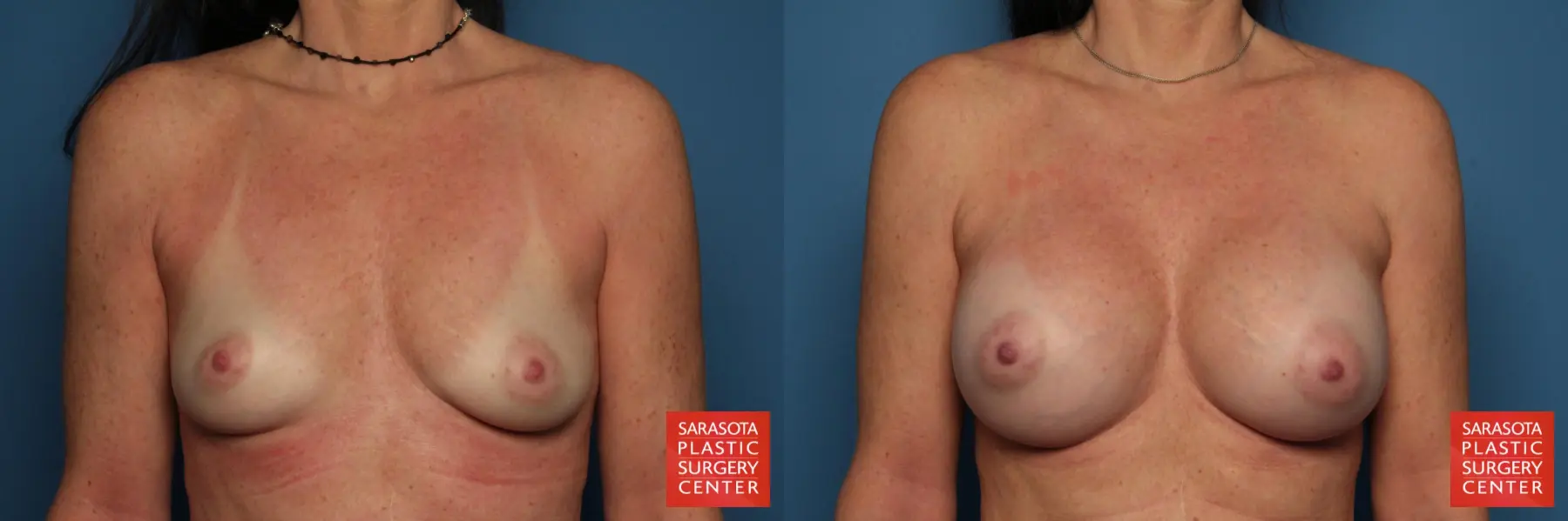 Breast Augmentation: Patient 41 - Before and After 1