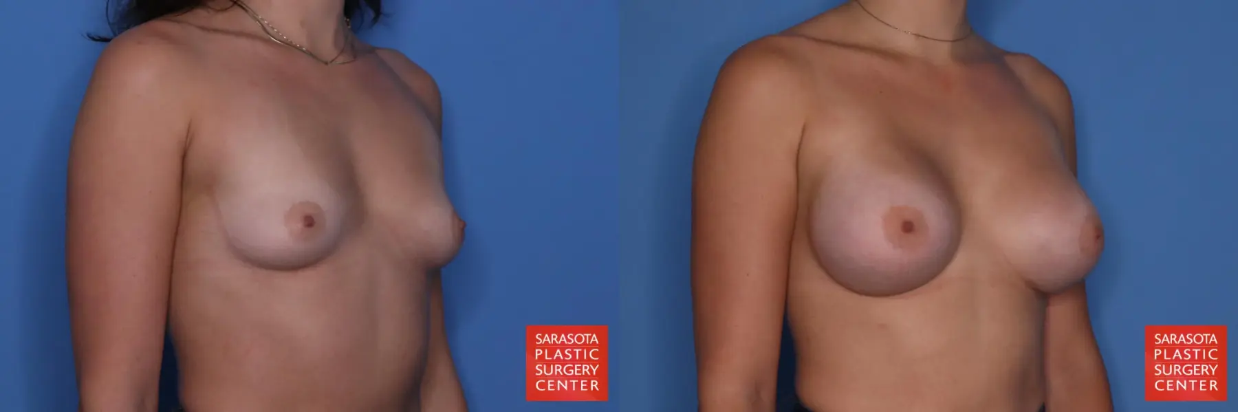 Breast Augmentation: Patient 75 - Before and After 2
