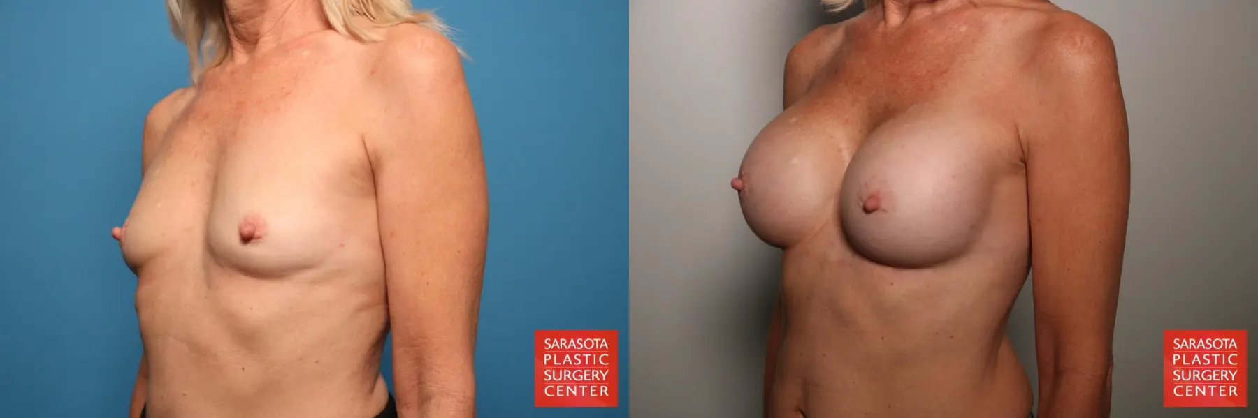 Breast Augmentation: Patient 58 - Before and After 2