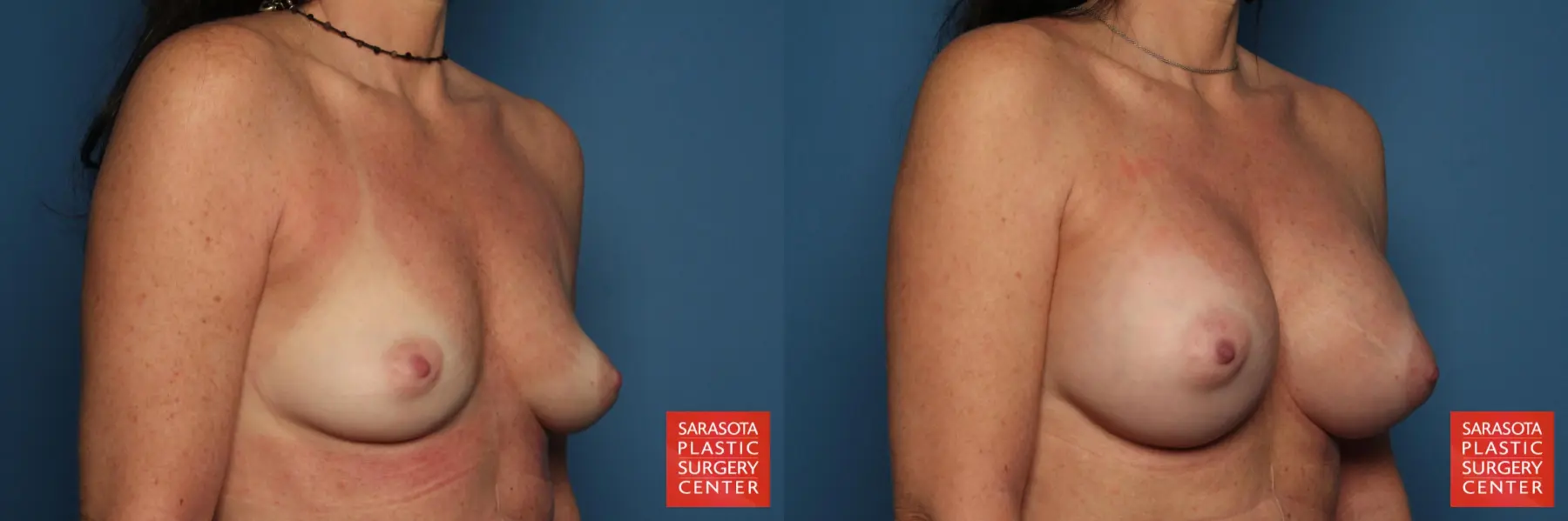 Breast Augmentation: Patient 41 - Before and After 2