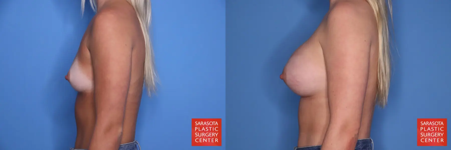 Breast Augmentation: Patient 202 - Before and After 3