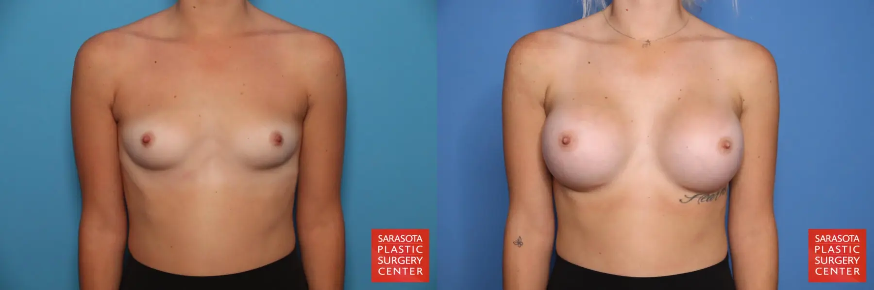 Breast Augmentation: Patient 15 - Before and After  