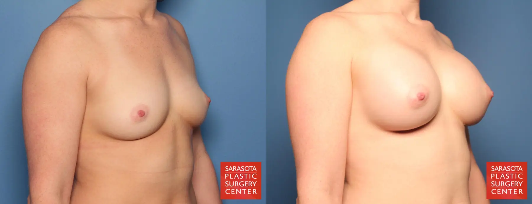 Breast Augmentation: Patient 84 - Before and After 2